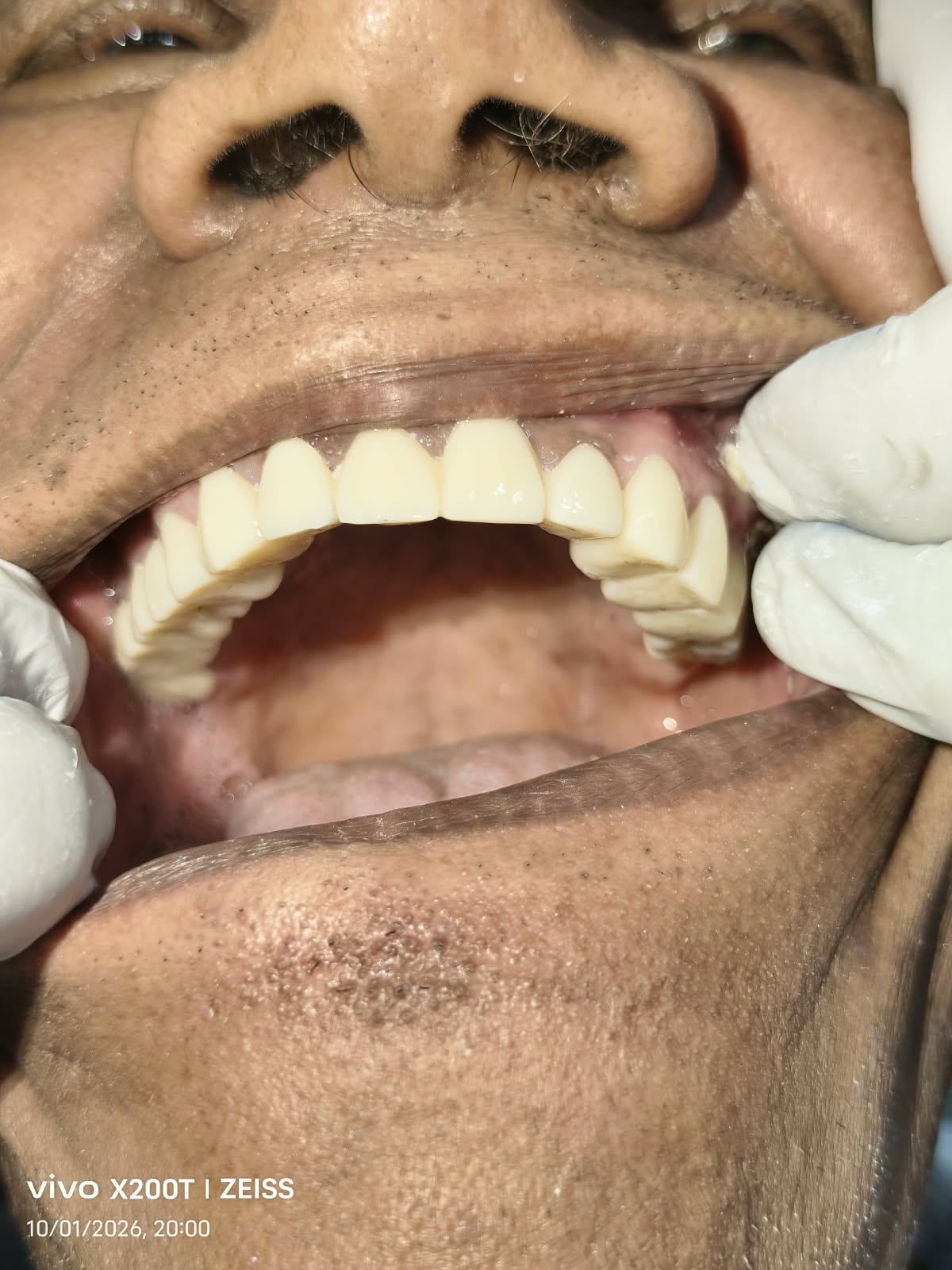 Dental Crowns and Bridges Meerut